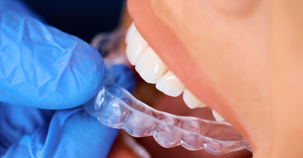 5 Expert Tips for Maintaining Your Invisalign in Garland