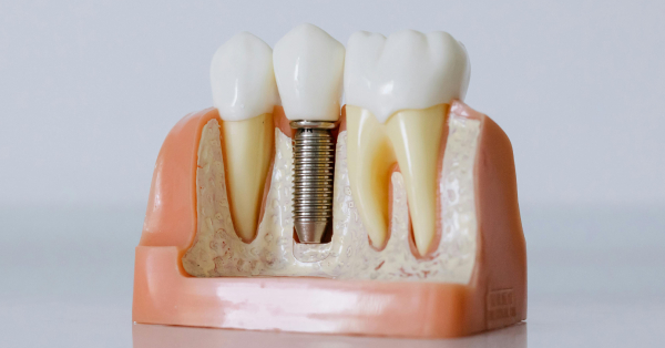 Frequently Asked Questions About Dental Implants in Garland